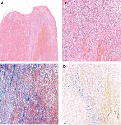 Sudden death associated with delayed cardiac rupture: case report and literature review